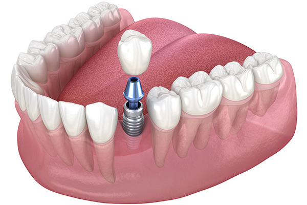 Dental Implants