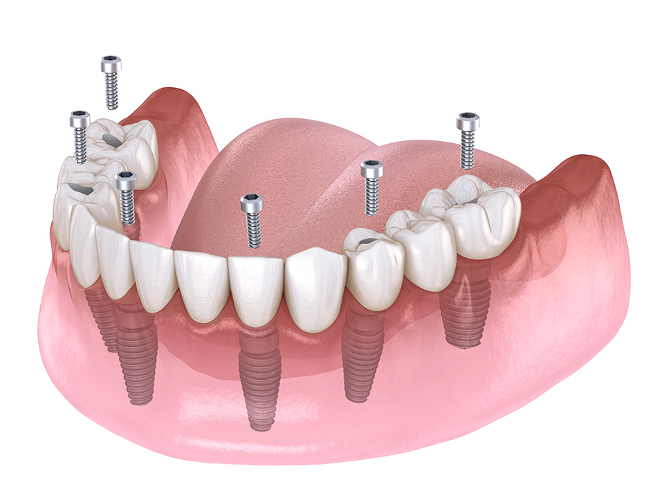 Dental Implants
