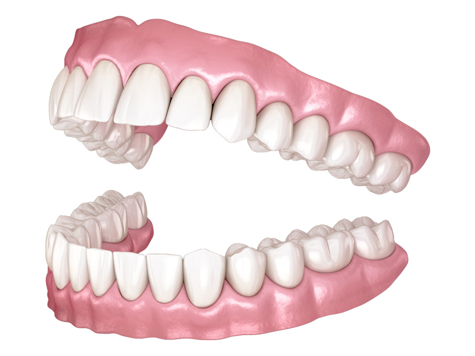 Traditional Dentures