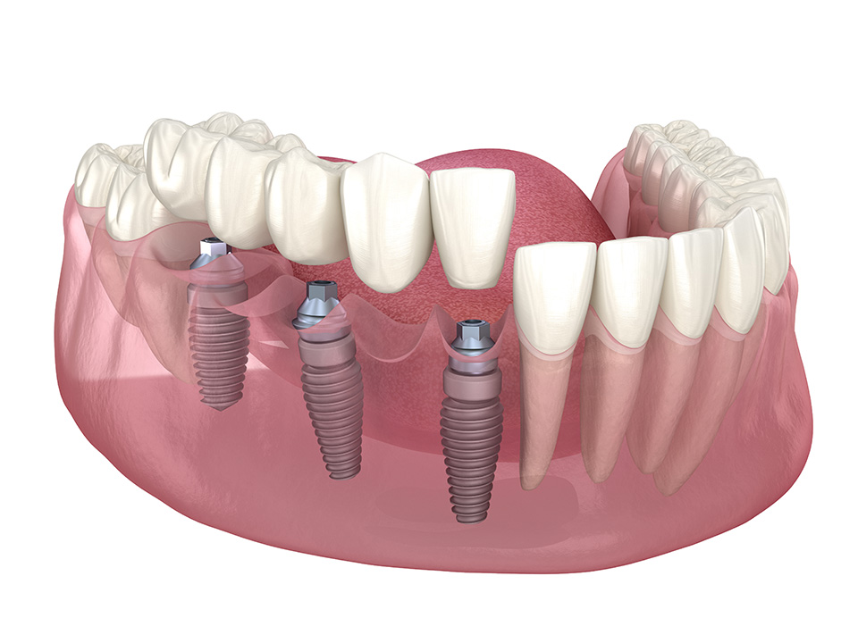 Dental Implants