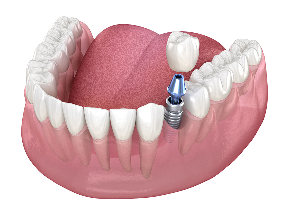 Dental Implants
